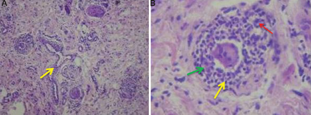 Haematoxylin and eosin-stained histopathology pictures revealed (A) non-caseating granulomas along with dilated blood capillaries (yellow arrow) and lymphocytes (×10). (B) non-caseating granulomas are surrounded by histocytes (green arrow), lymphocytes (yellow arrow), blood vessels and multinucleated giant cells (red arrow) (×40).
